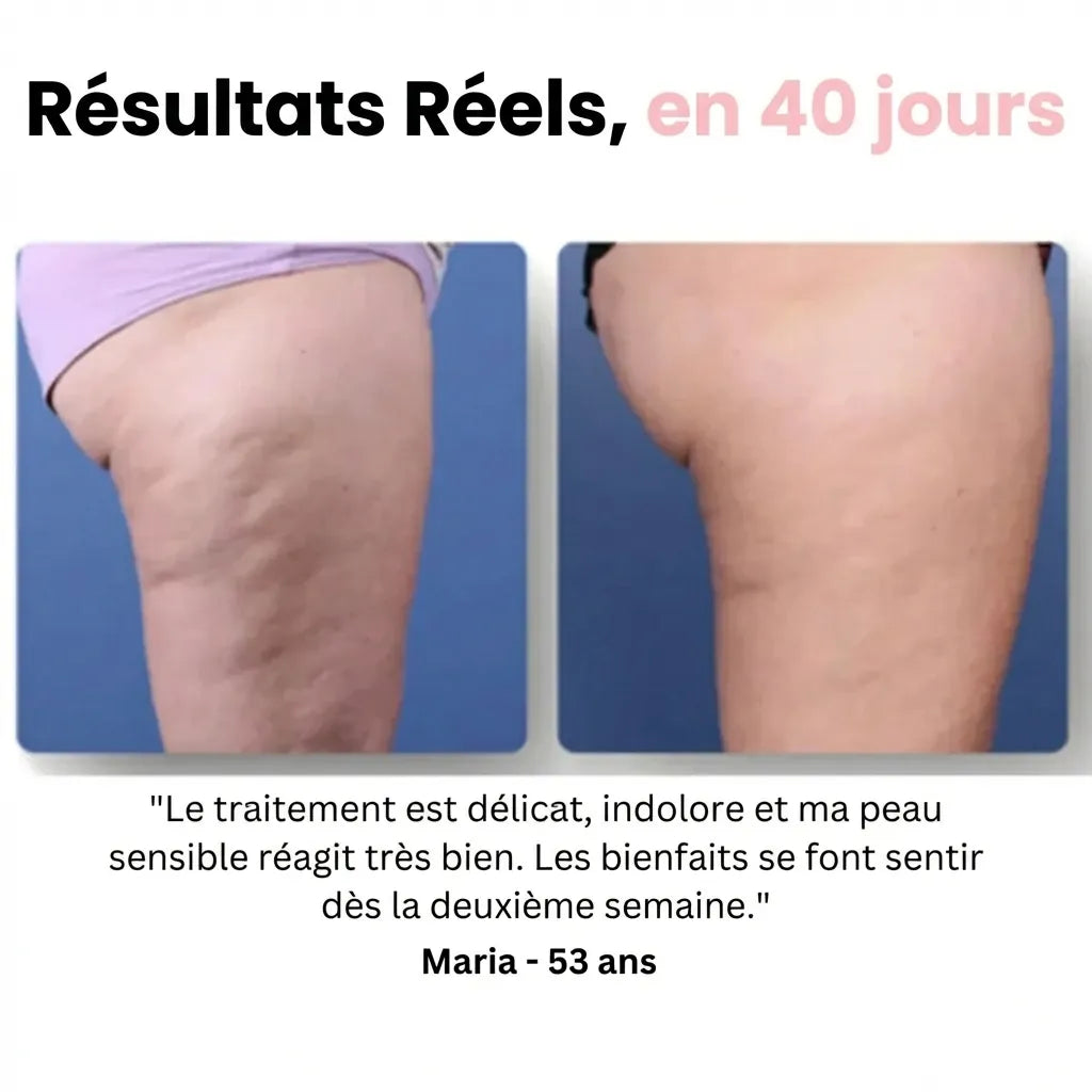 Sôra Sculpt – Masseur Drainant Anti-Cellulite